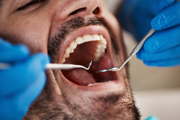 Emergency Dental Filling Replacement in AR