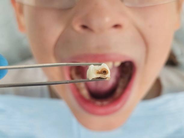 Best Dentist for Tooth Abscess  in Mccrory, AR